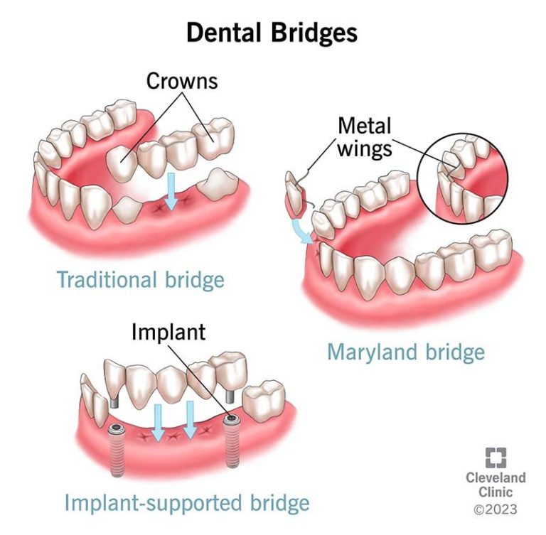what-does-a-temporary-bridge-look-like_1753276289