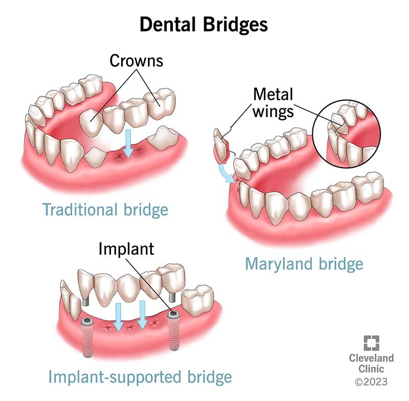 what-does-a-temporary-bridge-look-like_1753276289